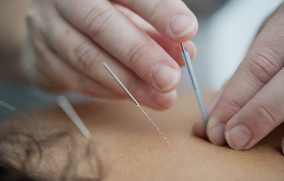 DRY NEEDLING: HOW IT WORKS AND ITS BENEFITS FOR PAIN RELIEF